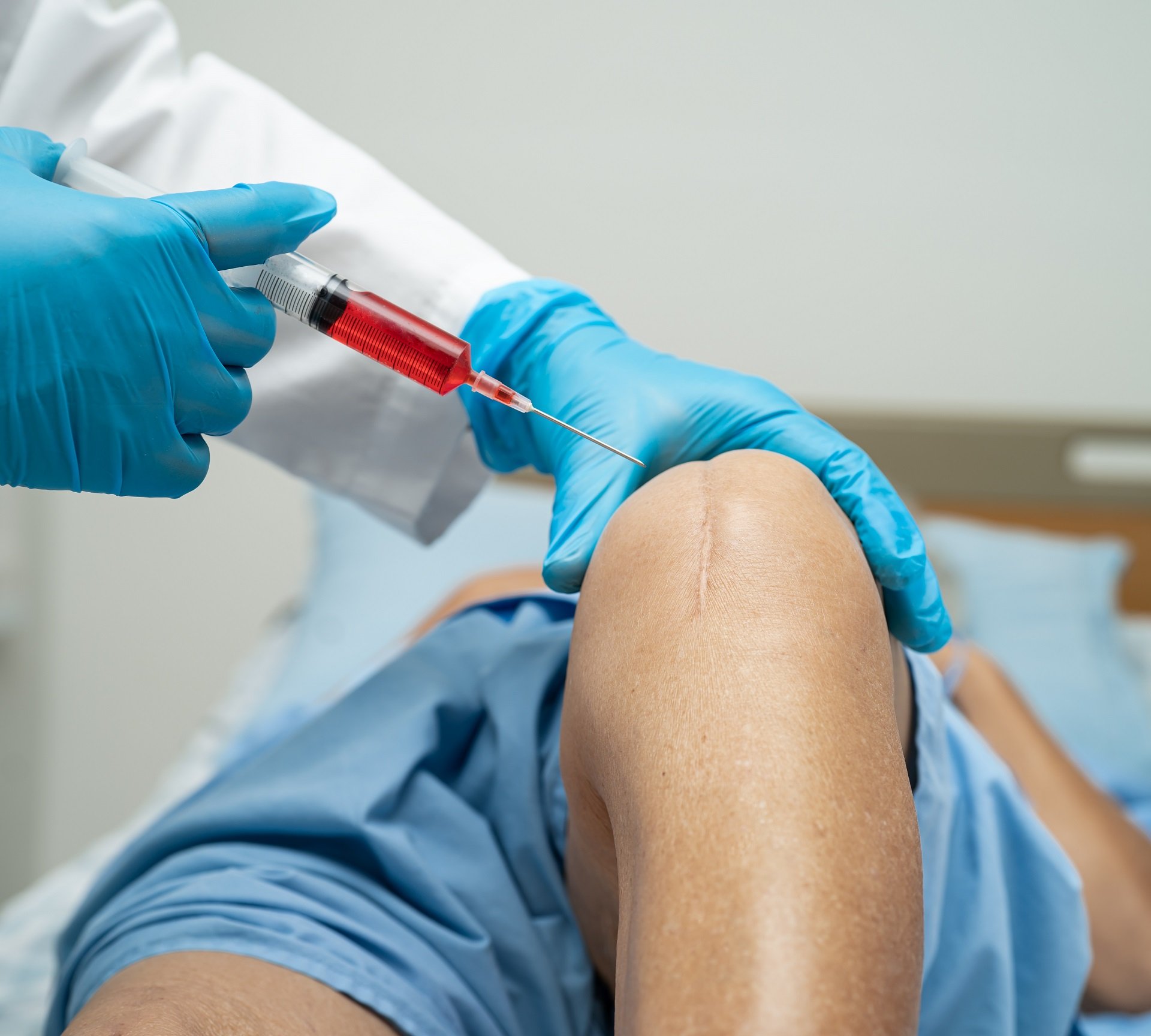 PRP plasma therapy